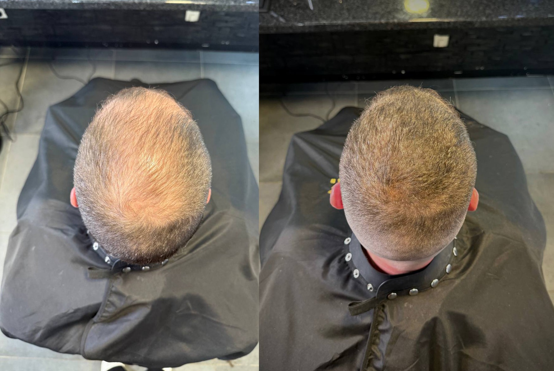 correction-calvitie-mcc-1