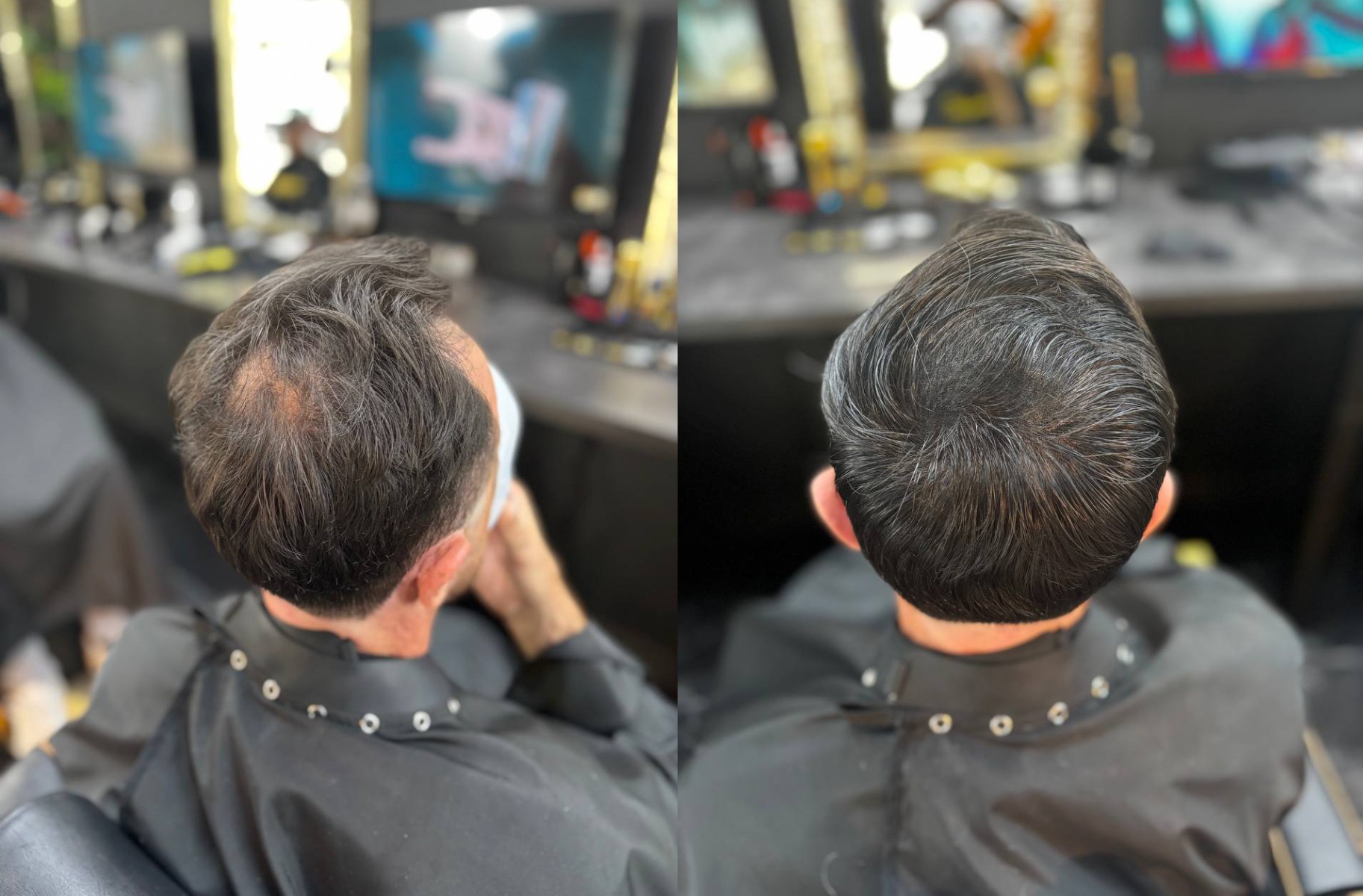 correction-calvitie-mcc-3