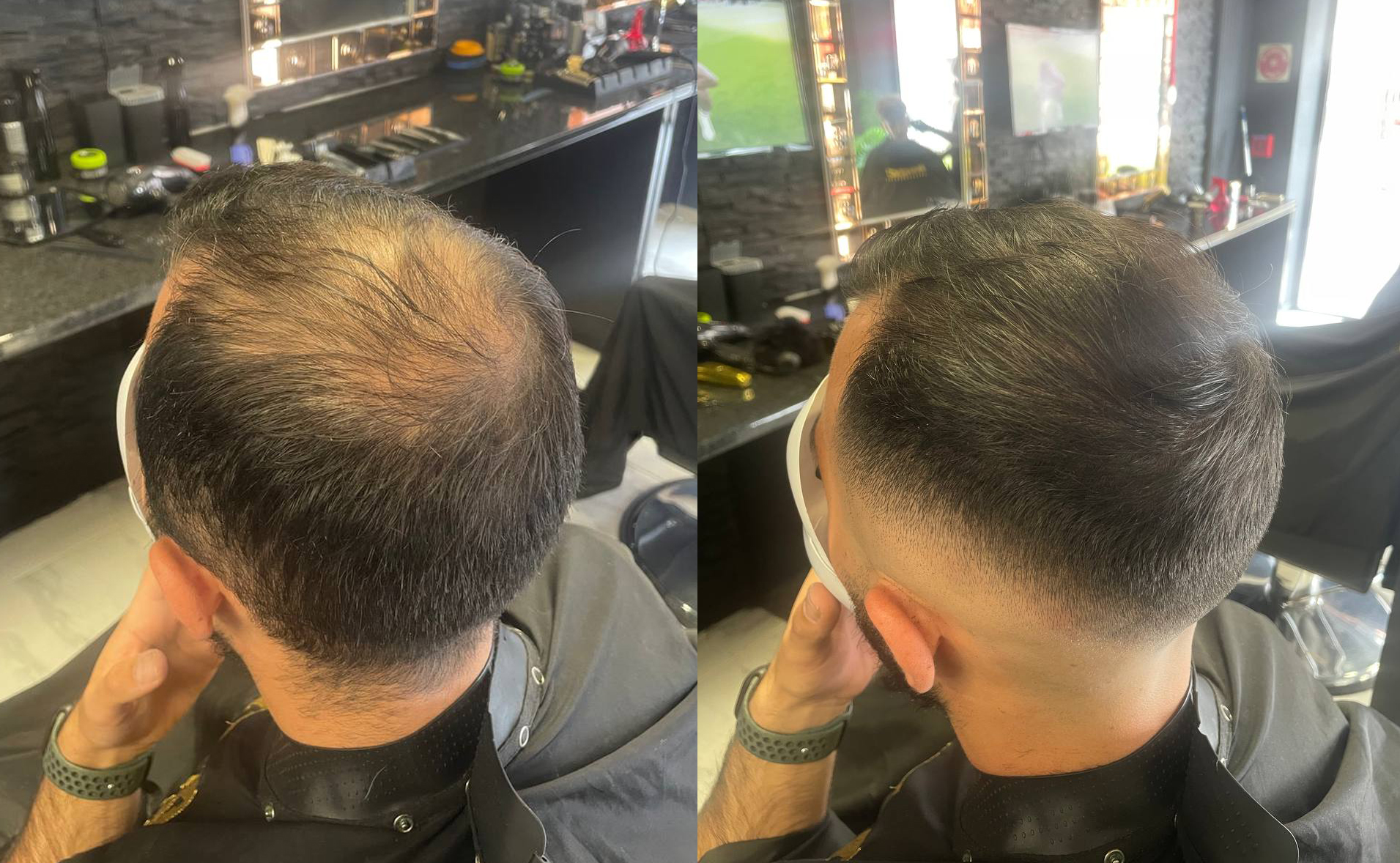 correction-calvitie-mcc-5